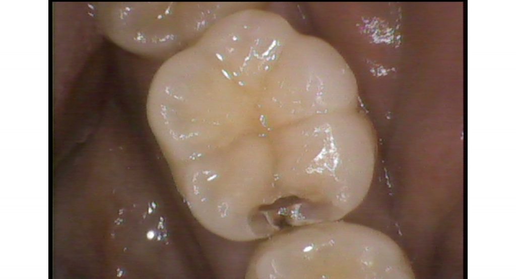 デンタルフロス（糸ようじ）を使用しないと虫歯になる場合があります | アーブル歯科クリニック