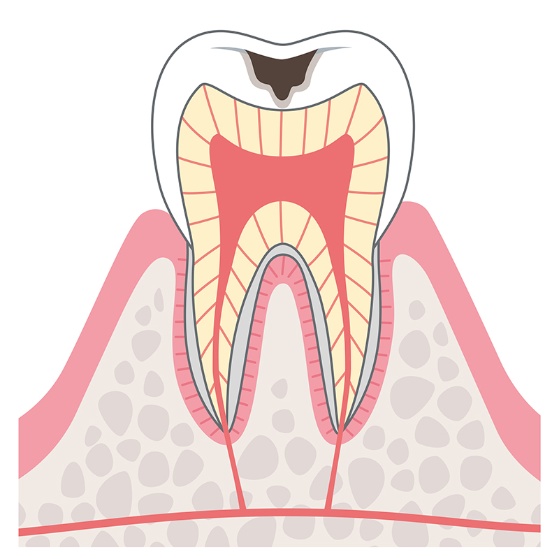 C1　エナメル質に達したむし歯