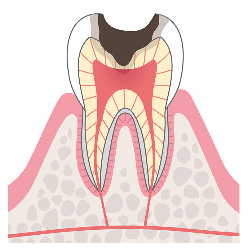 C2　象牙質に達したむし歯