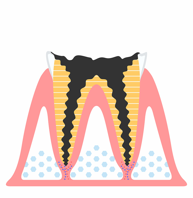 C4　歯根にまで達したむし歯