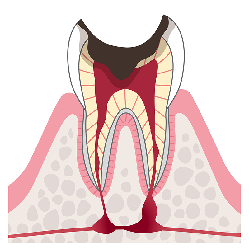C3　神経に達したむし歯