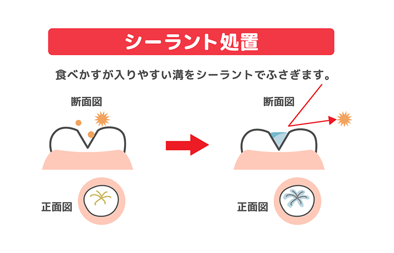 奥歯のむし歯予防にはシーラント