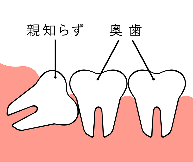 親知らずは抜いた方が良い？