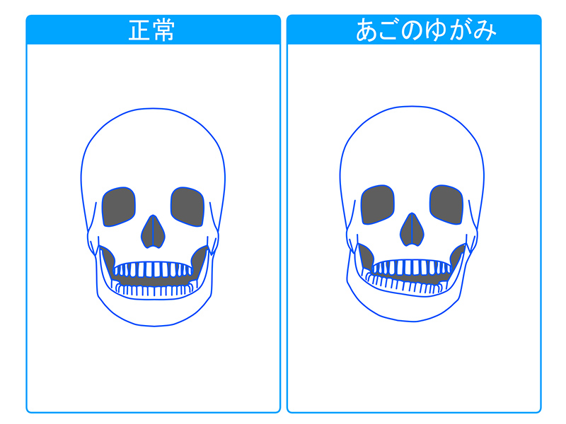 顎関節症の症状チェック