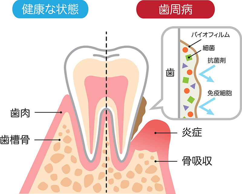 歯石取り・着色取り（歯周病治療）