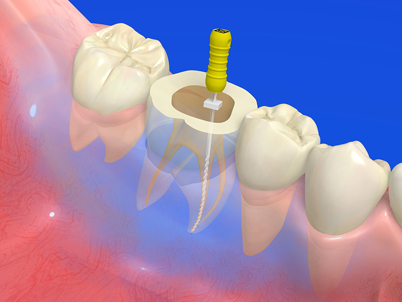 根管治療（歯の神経・根の治療）