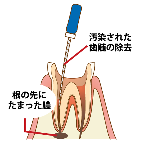 根管治療