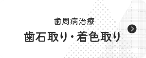 歯石取り・着色取り