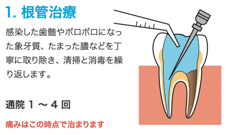 歯の神経を取る治療方法(虫歯が深く神経を取る処置をおこなう方法) アーブル歯科クリニック