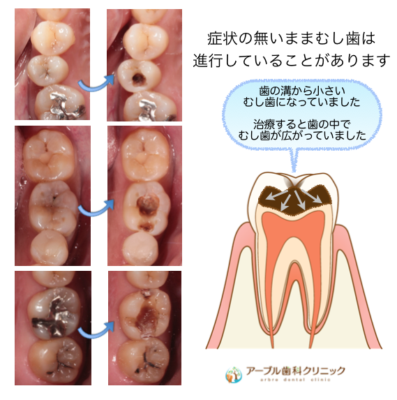 歯 の 神経 を 抜く 方法