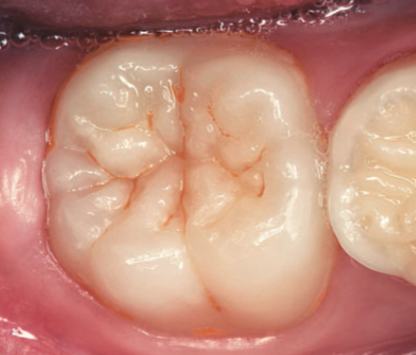 歯 の 溝