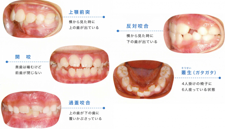 プレオルソこども歯ならび矯正法