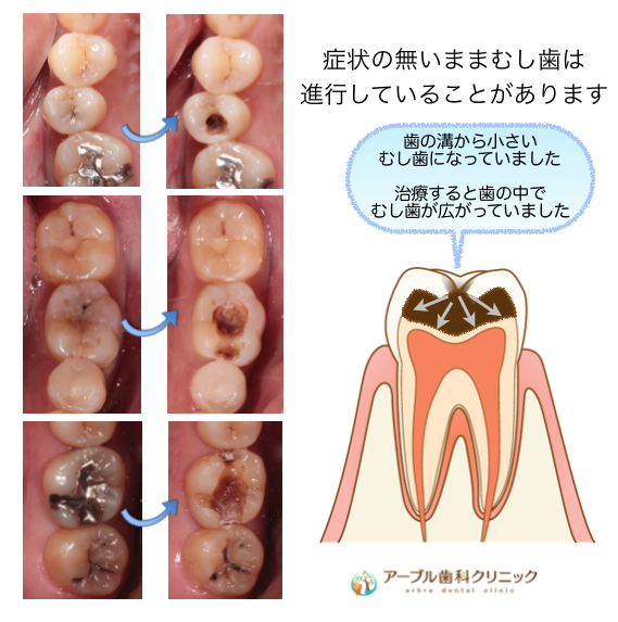 虫歯 の 手前