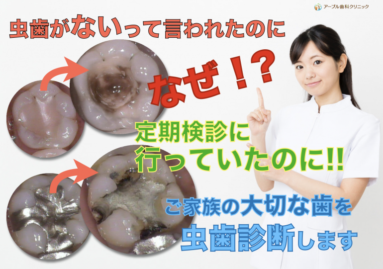 見た目はC1程度の虫歯の大きさだけど治療したらC2レベルの虫歯の進行で 